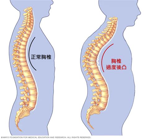 駝背造成的影響